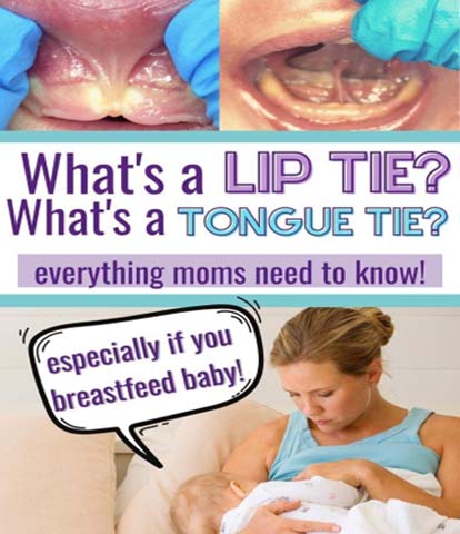 Live Chennai: Tongue Tie: Understanding Its Impact ,Tongue Tie ...