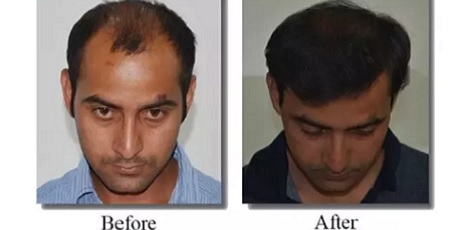 What are the benefits of Hair Transplant  Apollo Cosmetic Clinics
